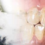 Five Ways Vaping Ruins Your Teeth – And One Is Irreversible
