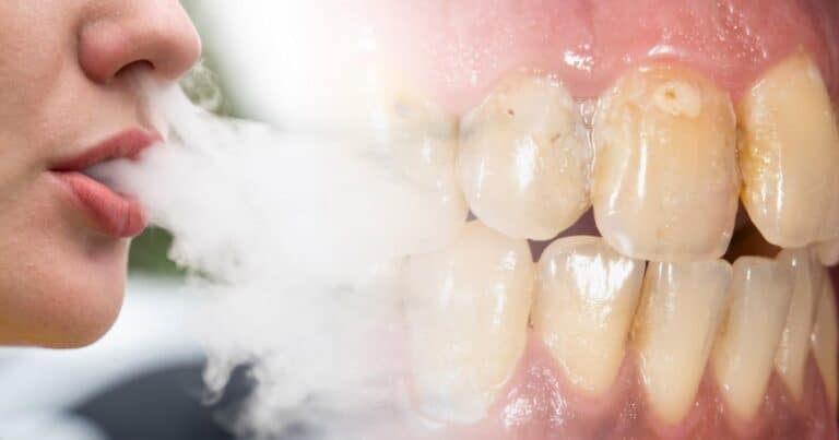 Five Ways Vaping Ruins Your Teeth – And One Is Irreversible