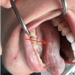 Potential Association Between Vaping And Recurrent Aphthous Stomatitis: A Case Series