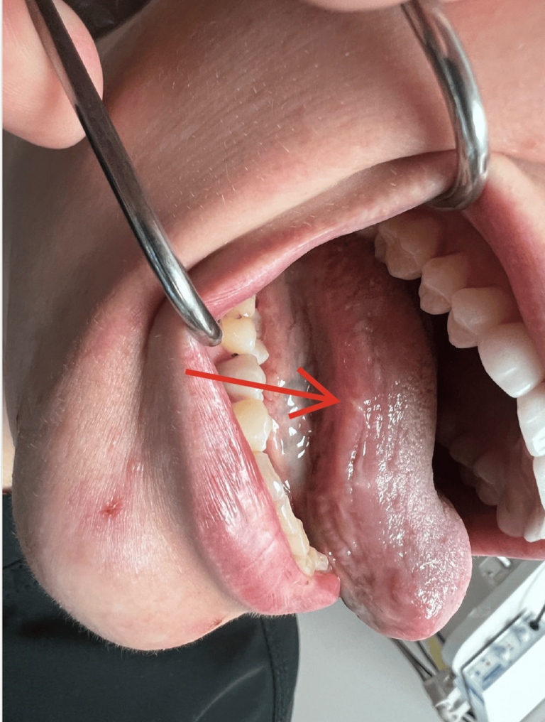 Potential Association Between Vaping And Recurrent Aphthous Stomatitis: A Case Series
