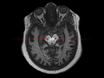 New Study Reveals Potential Biological Link Between Cannabis And Psychosis