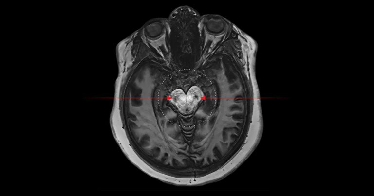 New Study Reveals Potential Biological Link Between Cannabis And Psychosis